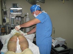 smartlaser lipo plastic surgeon fat reduction图2