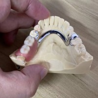 Total Implant PFM Bridge China Dental Lab